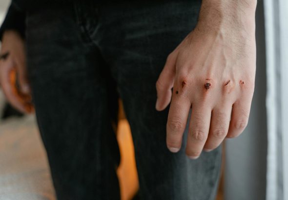 Detailed image of a hand with visible wounds and scratches, emphasizing injury.